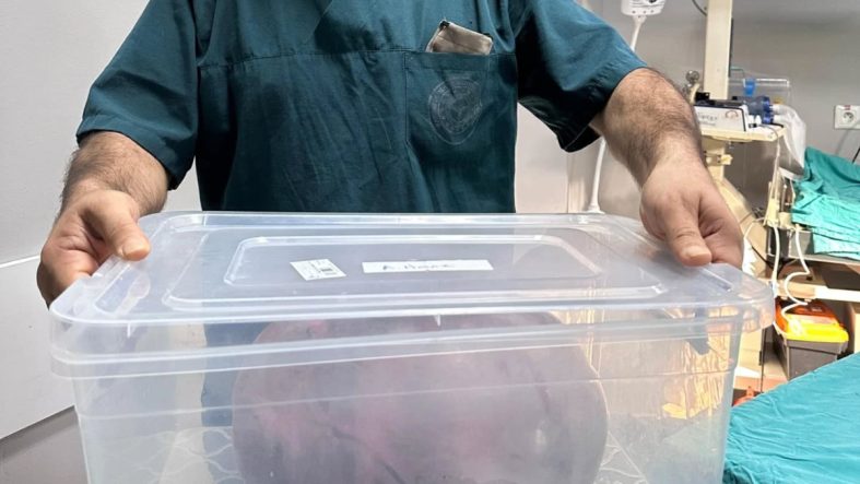 Trabzon’da yumurtalıklarından 9 kiloluk kitle çıktı