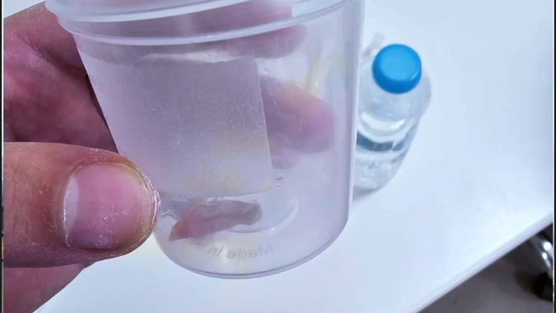 Malatya'da 1,5 yıllık öksürüğün nedeni kabak çekirdeği çıktı